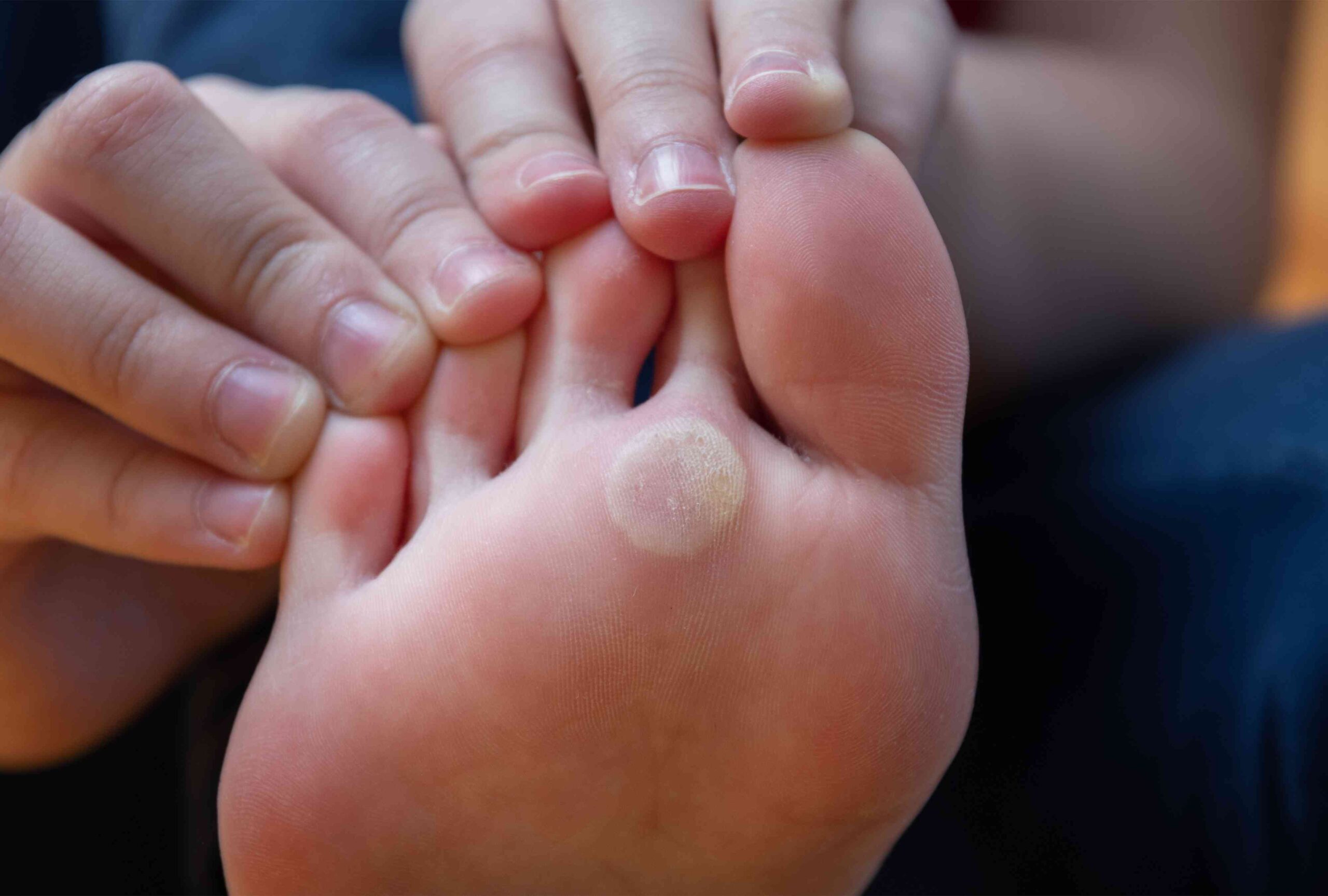 Callus Treatment